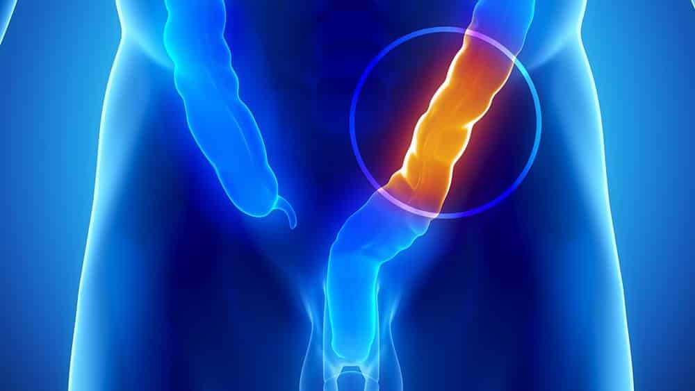 cancer do intestino grosso